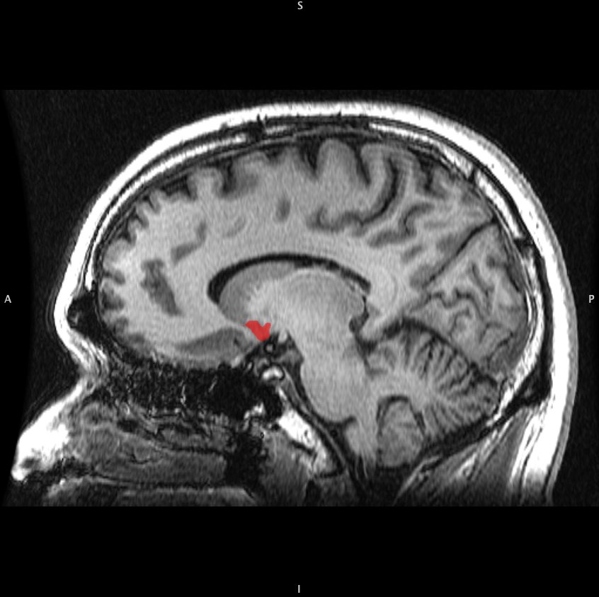 nucleus accumbens sag